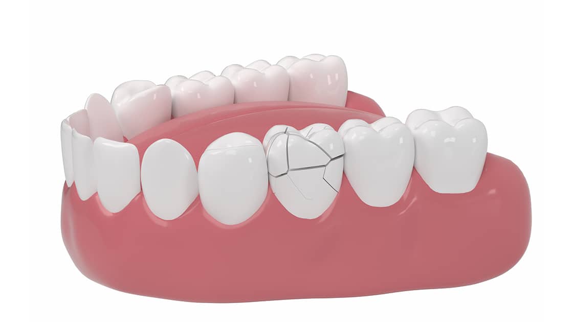 Cracked Teeth Photo
